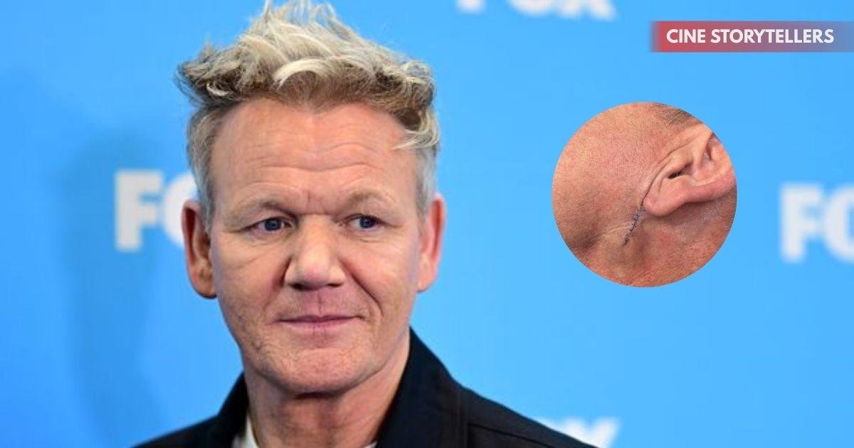 Gordon Ramsay Skin Cancer Diagnosis 2025: What You Need to Know